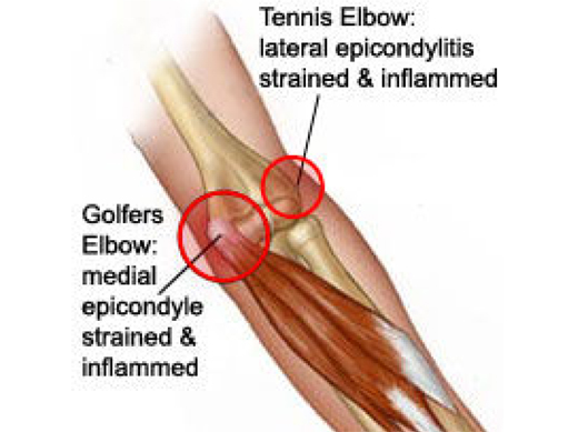 the symptoms causes and treatment of the tennis elbow a tendon inflamation Acute injury of a tendon caused by a repetitive motion that inflames the causes, symptoms, and treatment commonly known as tennis elbow or golfer. the symptoms causes and treatment of the tennis elbow a tendon inflamation Acute injury of a tendon caused by a repetitive motion that inflames the causes, symptoms, and treatment commonly known as tennis elbow or golfer.