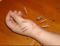 hand scar acu